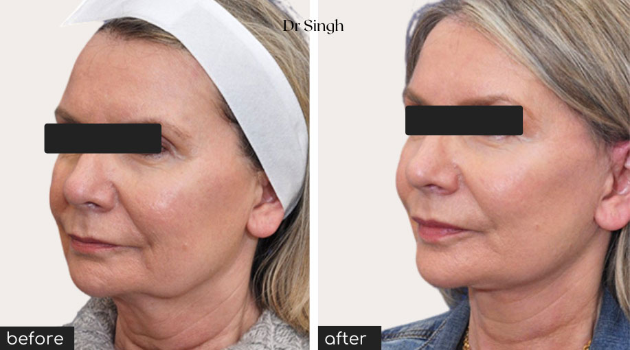 before after mini face lift nyc